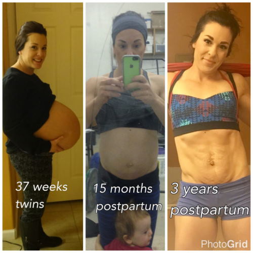 diastasis progression timeline