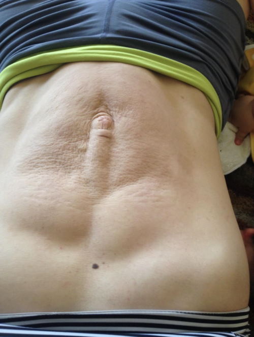 diastasis recti coning stomach