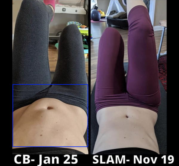 diastasis recti doming stomach