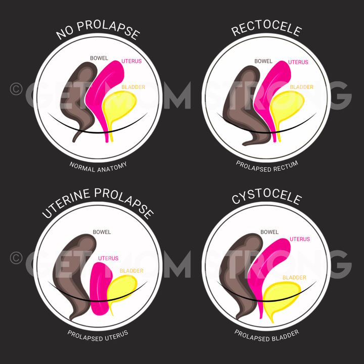 types of prolapse